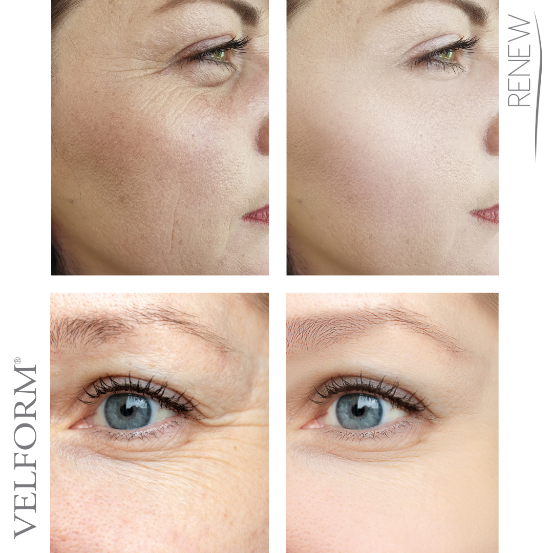 Velform Renew: Tu piel, más joven y radiante en cada uso ✨